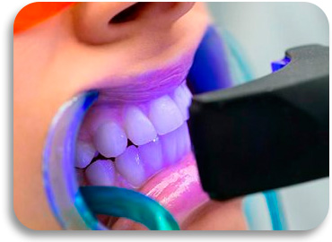 Blanqueamiento Dental