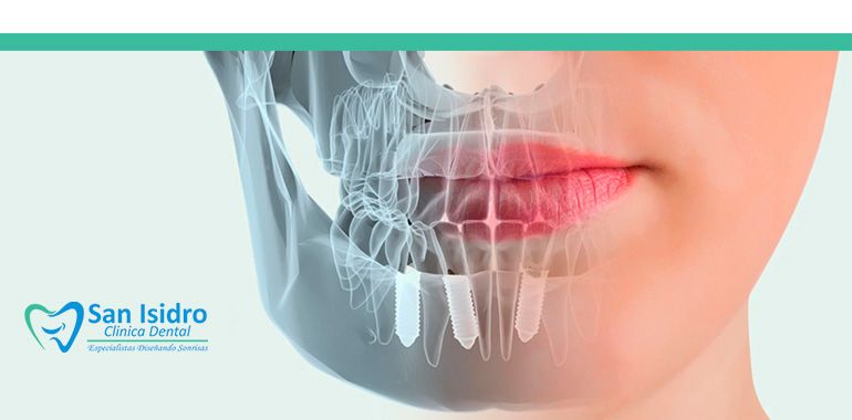 implantologia-oral-sjl